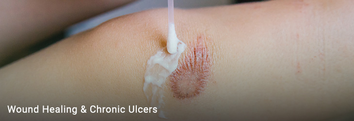 Wound Care and Chronic Ulcer Management